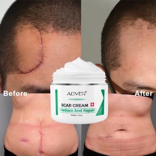 ของแท้ ALIVER ครีมลดรอยแผลเป็น แผลเป็น รแผลไฟไหม้ น้ำร้อนลว แผลผ่าตัด รอยแตกลายหลังครรภ์ แผลเป็นใหม่และแผลเป็นเก่า 50ml