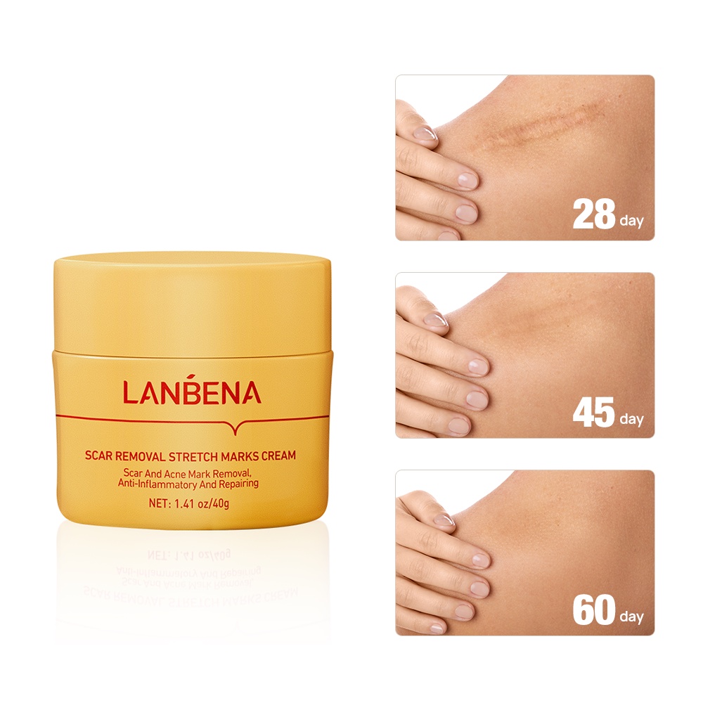 LANBENA Scar Removal Cream Acne Stretch Marks Treatment Moisturizer Skin Care 40g