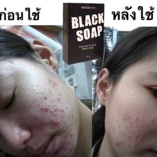 ส่งไว สบู่ถ่าน ชาร์โคล ผสมกลูต้า​คอลลาเจน​ 🚀ส่งด่วน2ชม กรุงเทพ ปริมณฑล ⚫