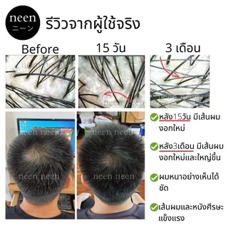 เซรั่มแชมพู ลดผมร่วง เร่งผมใหม่ ปลูกผม ลดคัน ลดรังแค ลดแพ้และอักเสบ neen Anti Hair Loss Serum Shampoo