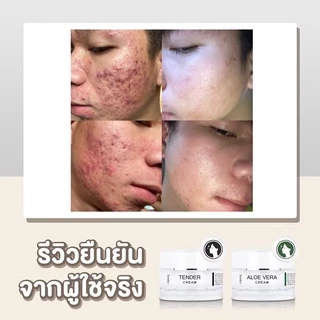 เซตรักษาสิว รอยสิว เพิ่มความชุ่มชื้น