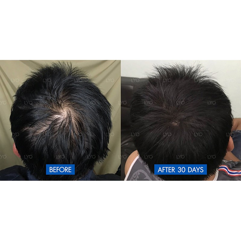 LYO ไลโอ หนุ่มกรรชัย #ส่งจากบริษัท  | ครบชุด แฮร์โทนิค แชมพู ครีมนวด lyo shampoo lyo hair tonic ช่วยลดผมร่วง - รูปที่ 6