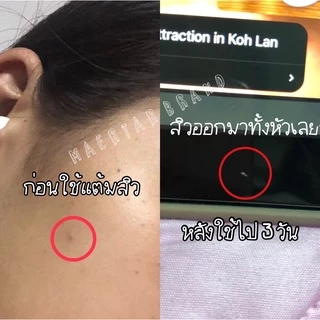 Anti Acne (พร้อมส่ง) แต้มสิวสมุนไพร สิวอักเสบ สิวหนอง สิวผดยุบ! Maertar Anti Acne