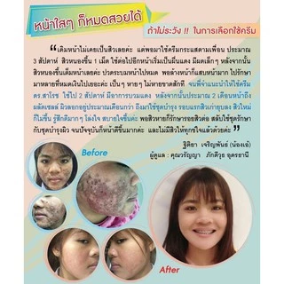 ดร.สาโรช เฮอร์เบิล แอคเน่เคลียร์ โลชั่น (โลชั่นสิว) สำหรับสิวอุดตัน สิวอักเสบ ส่งฟรี