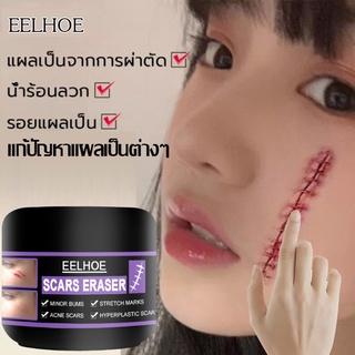 EELHOE ‍⚕️50gครีมลบแผลเป็น ครีมทาแผลเป็น ครีมลดรอยแผลเป็น ครีมแก้ขาลาย แผลน้ำร้อนลวก แผลผ่าตัดเป็นต้น เร่งการซ่อมแซมให้ผ