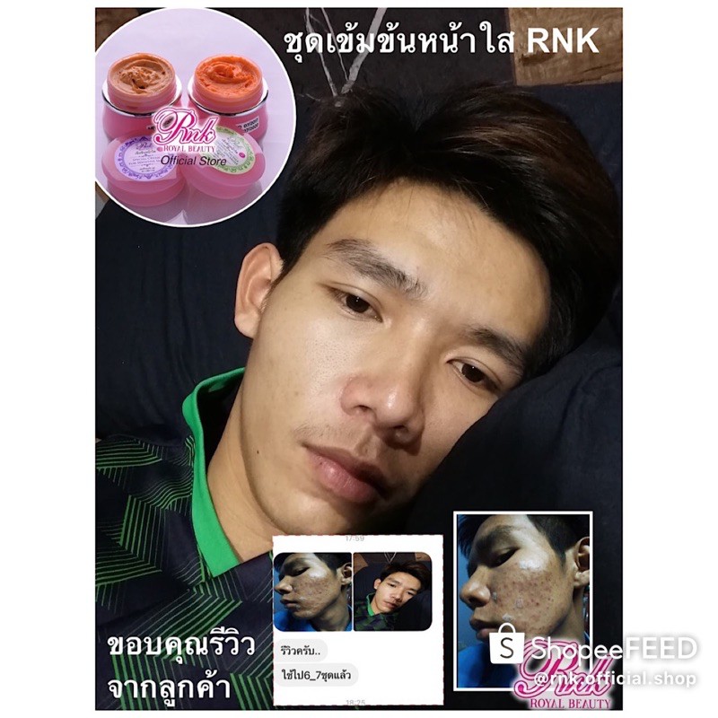 RNK set. 4 ชุดเข้มข้นพร้อมสบู่สิว สำหรับผิวที่เป็นสิวง่ายและมีผิวมัน จัดส่งฟรี รูปที่ 7