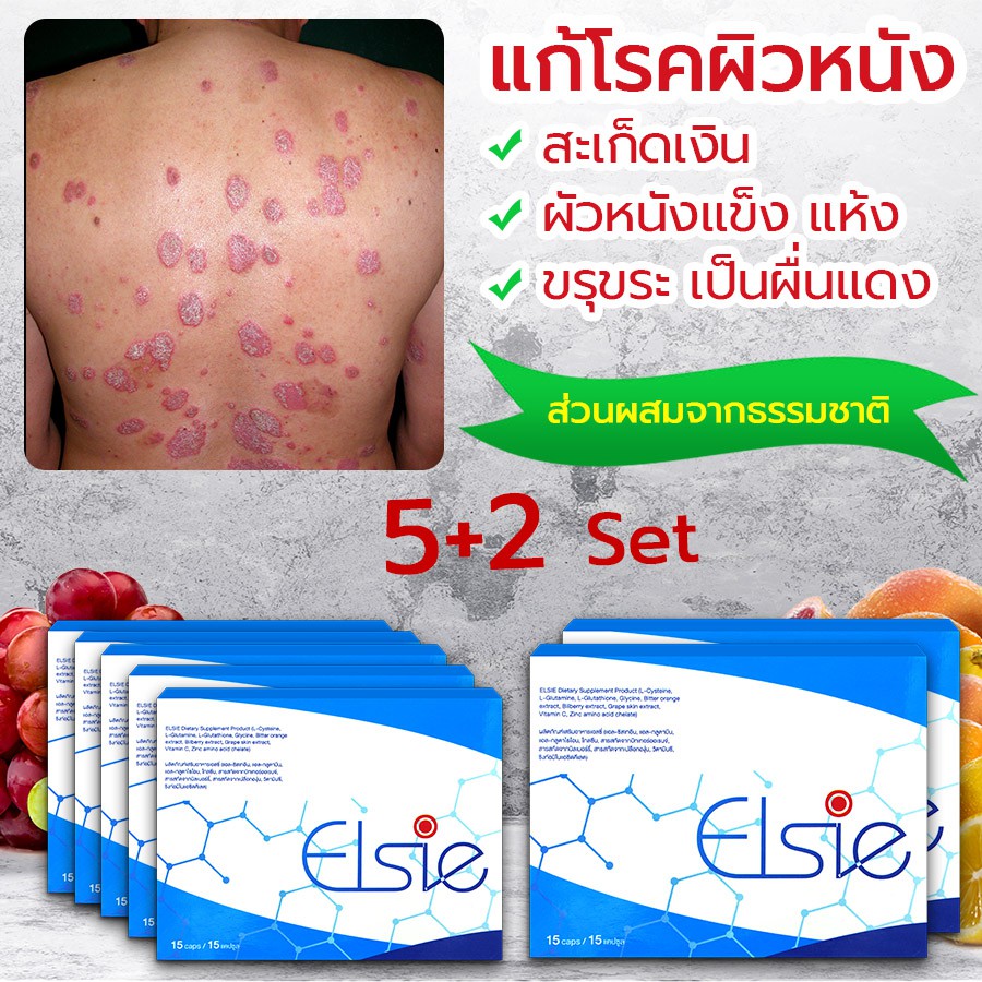 🔥 ELSIE ผลิตภัณฑ์บำบัดรักษาโรคสะเก็ดเงิน กำจัดเชื้อโรค ขับล้างสารพิษ ทำลายแบคทีเรีย ขจัดเซลล์ผิวตาย ☘️ ซื้อ 5 แถม 2