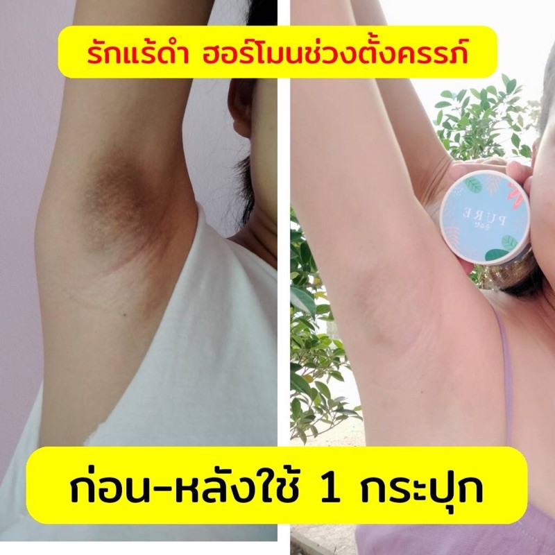 ครีมPure ทารักแร้ขาว