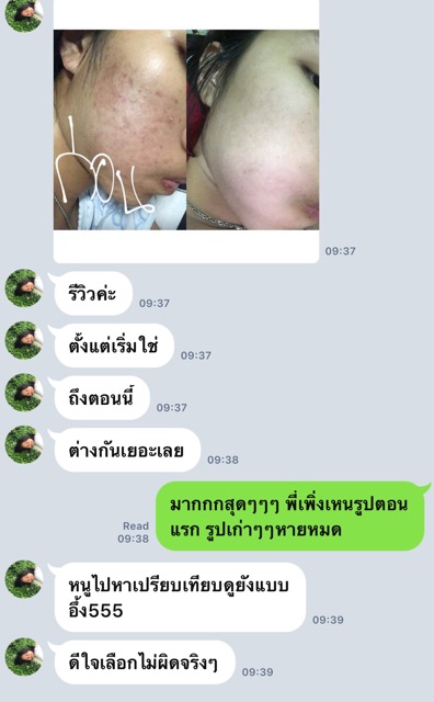 AMOUR Acne Lotion for acne ราคา ถูกที่สุด ดีลบีเคเค แกลเลอรีภาพที่ 3
