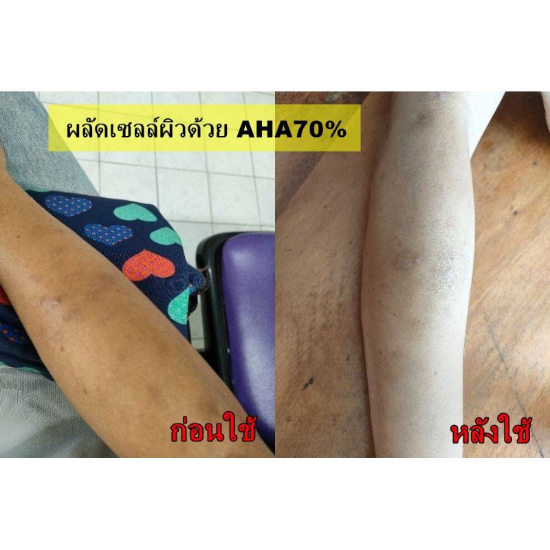 AHA70% กรดผลไม้ ทรีทเมนต์ผิว Glycolic acid ราคา ถูกที่สุด ดีลบีเคเค แกลเลอรีภาพที่ 2