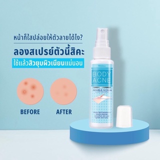 Mistine Body Acne Double Action Clarifying Spray 50 ml. มิสทิน บอดี้ แอคเน่ สเปรย์ฉีดสิวที่หลัง ป้องกันการเกิดสิวที่หลัง