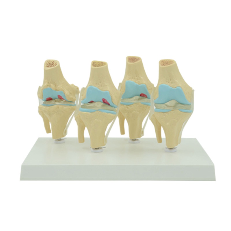 QUU ยืดหยุ่น Human Knee Joint Anatomy รุ่น Comparison of Knee Joint รุ่น Life Size