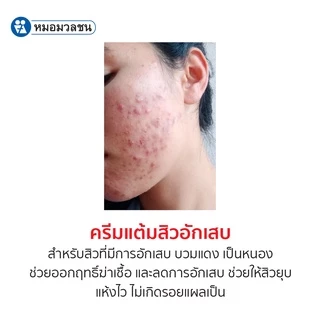 หมอมวลชน แอคซิน สปอต เอ็น แอคเน่ ครีม (Accin Spot N Acne Cream ) ครีมแต้มสิวอักเสบ