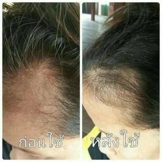 ❗แพ็คคู่ สเปรย์​ปลูก​ผม เร่งผมยาว แก้ผมร่วง ผมบาง ลดรังแค 1 ขวด➕เซรั่ม​ ปลูก​คิ้ว หนวด​ เครา​​ 1 ขวด