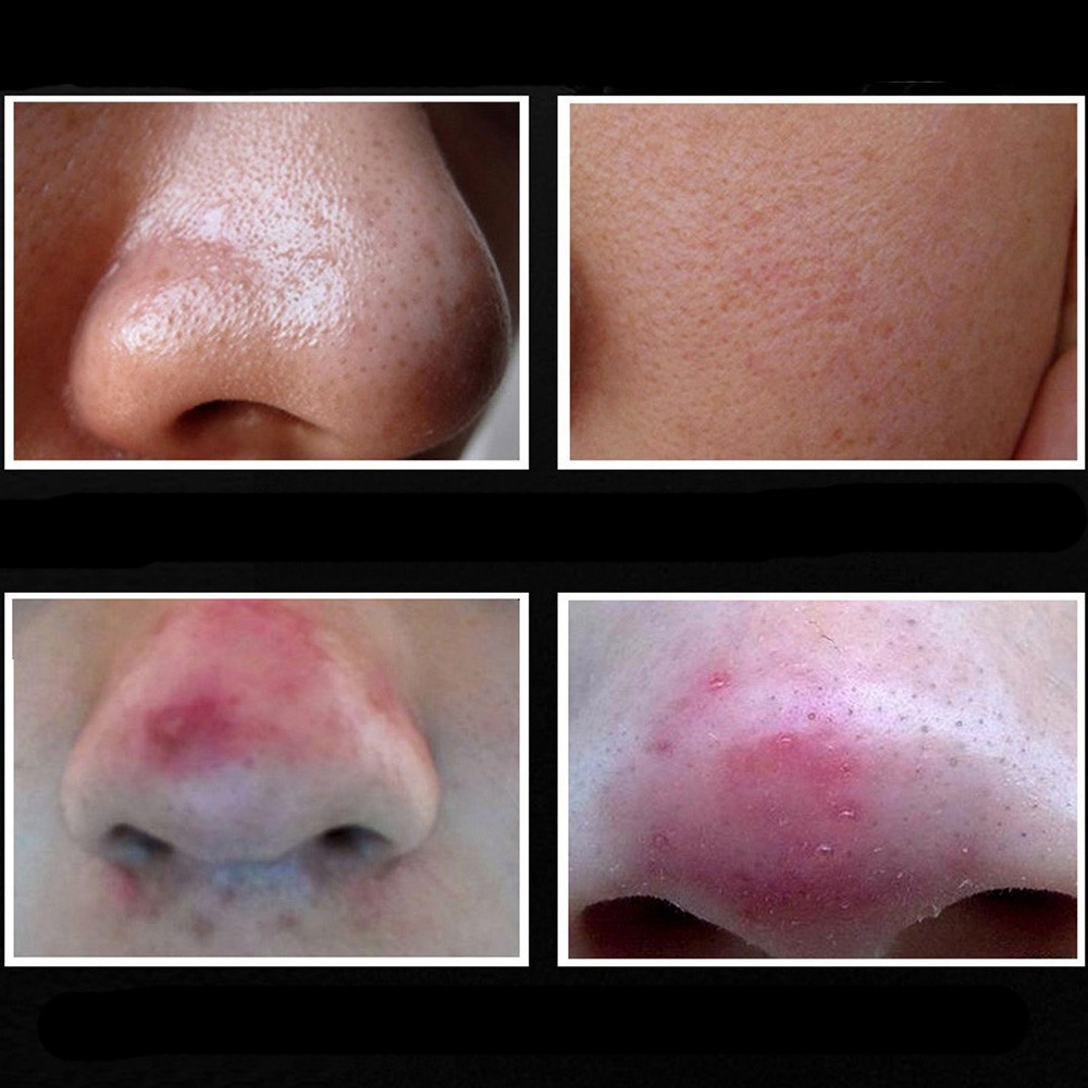 มาสก์ลอกกำจัดสิวเสี้ยน สิวหัวดำ สำหรับจมูก - รูปที่ 2