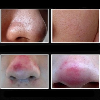มาสก์ลอกกำจัดสิวเสี้ยน สิวหัวดำ สำหรับจมูก