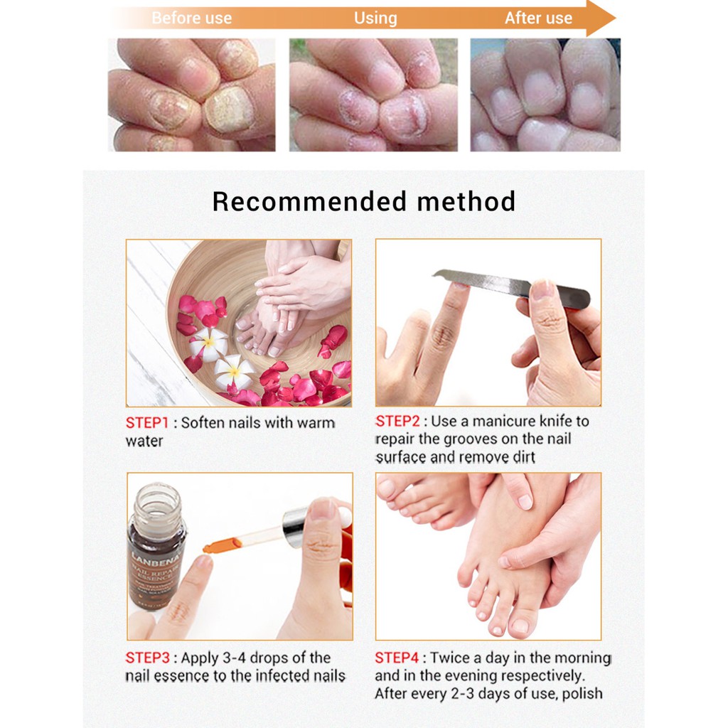 LANBENA เอสเซ้นส์ซ่อมแซมเล็บ Fungal Nail Treatment ลบ Onychomycosis Toe Nourishing Brighten Hand Foot Skin Care - รูปที่ 6