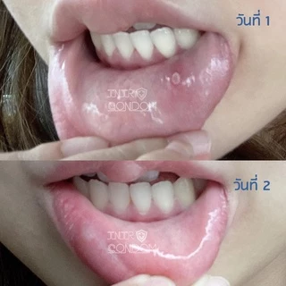 แผ่นแปะร้อนในแบบละลาย TIME ORAL ULCER PATCH ร้อนใน (แบบบรรจุ 4 ชิ้น และ รุ่นกล่อง บรรจุ 6 ชิ้น)
