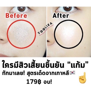 ถุงนิ้วขัดสิวเสี้ยน