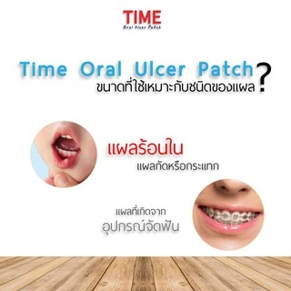 แผ่นปิดแผลในปาก Time Oral Ulcer Patch 1.5 Cm. แผลร้อนใน แผลในปาก ร้อนใน เหล็กติดฟัน ถูกสุด