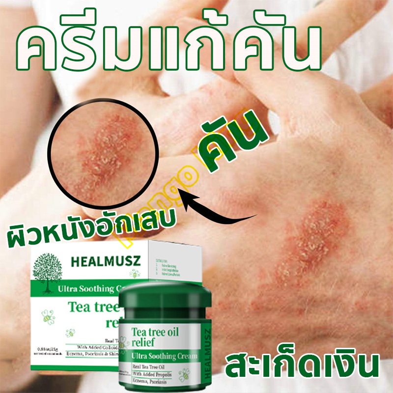 #HEALMUSZ
#ผื่นแพ้
#สะเก็ดเงิน
#กลากเกลื้อน
#ผดผื่นคัน