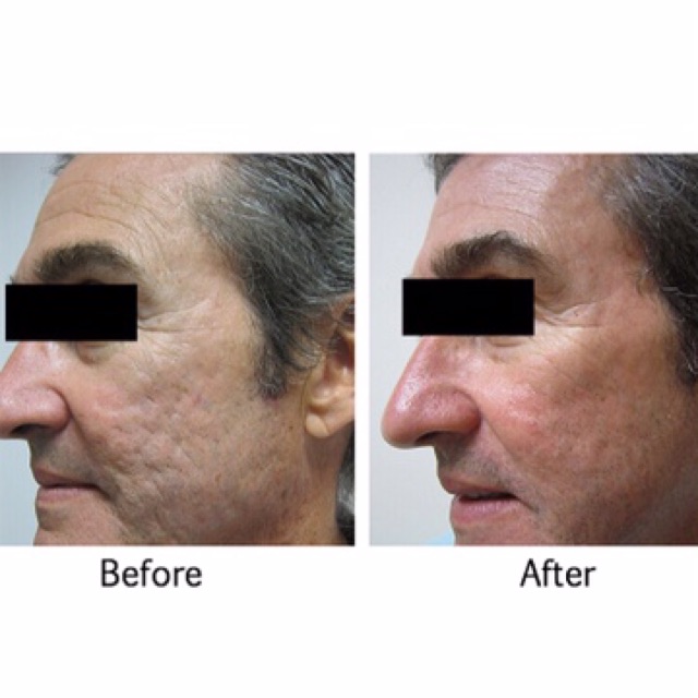 bioeffect before and after