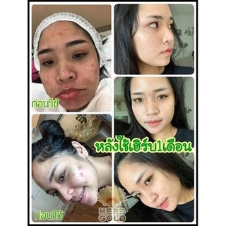 HERB Gold ครีมเฮิร์บ โกลด์ ชุด ครีม 30กรัม+ สบู่ 50 กรัม