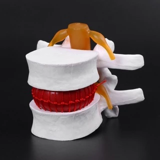 กายวิภาคของมนุษย์ Lumbar Disc Herniation Model การแพทย์ เรียนรู้ Aid Anatomy Instrume