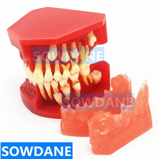 Dental Children Deciduous Teeth Model Replacement Model Permanent Teeth Alternate Display Removable Demonstration for Te