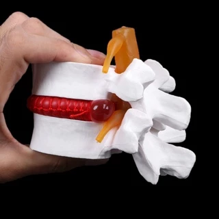กายวิภาคของมนุษย์ Lumbar Disc Herniation Model การแพทย์ เรียนรู้ Aid Anatomy Instrume