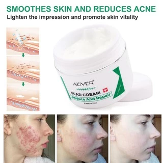 ของแท้ ALIVER ครีมลดรอยแผลเป็น แผลเป็น รแผลไฟไหม้ น้ำร้อนลว แผลผ่าตัด รอยแตกลายหลังครรภ์ แผลเป็นใหม่และแผลเป็นเก่า 50ml