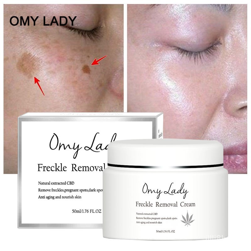 dark spots removal cream for ladies
