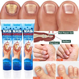 20g Nail Fungus Removal Cream Ointment Onychomycosis Fungal Nail  Anti Infection Treatment Paronychia Toenail Care Treat