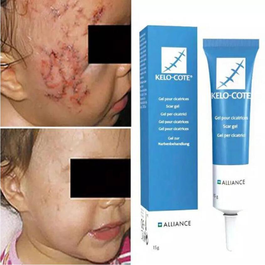 Kelo ·Cote scar Removal Cream repair stretch mark remover gel acne scar remover Scars Treatment 15g