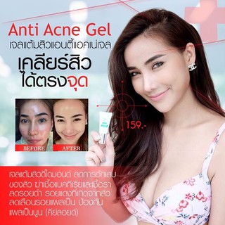 Anti Acne Gel เจลแต้มสิวแอนตี้แอคเน่