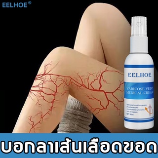 เชี่ยวชาญเรื่องเส้นเลือดขอด EELHOE เส้นเลือดขอด 30ml ปรับปรุงขาไส้เดือนบวมและความรุนแรง ครีมทาเส้นเลือดขอด ครีมทาเส้นขอด