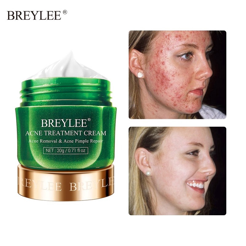BREYLEE Acne Treatment Cream Anti Acne Face Cream Scar Removal Cream Skin Care Whitening Repair Pimple Remover for Acne