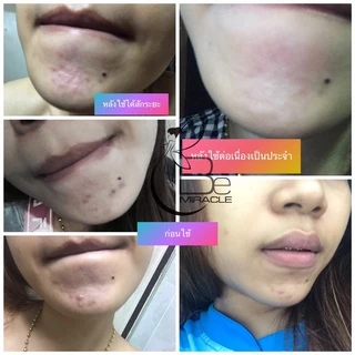 White Cream anti-acne ( บีมิราเคิลครีม) ครีมหน้าใส ครีมลดสิว•ขนาดทดลอง5กรัม•