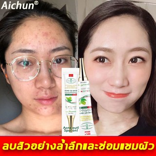 aichunครีมลบรอยดำสิว30mlรักษาสิวอย่างล้ำลึก ซ่อมแซมรอยสิวและหลุมสิว ครีมลดรอยสิว ครีมแต้มสิว เซรั่มกำจัดสิว ครีมกำจัดสิว