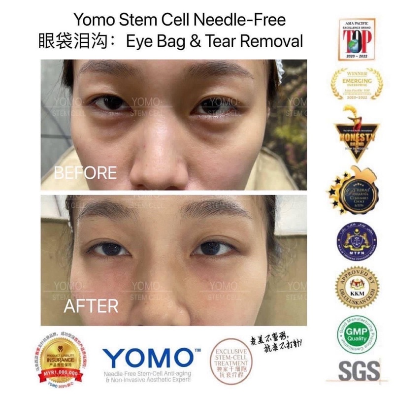 YOMO Needleless Stem Cell Tear Groove Dark Circles 2 Times Treatment Set