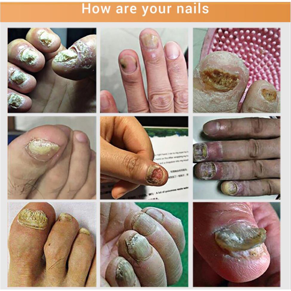 LANBENA เอสเซ้นส์ซ่อมแซมเล็บ Fungal Nail Treatment ลบ Onychomycosis Toe Nourishing Brighten Hand Foot Skin Care - รูปที่ 2