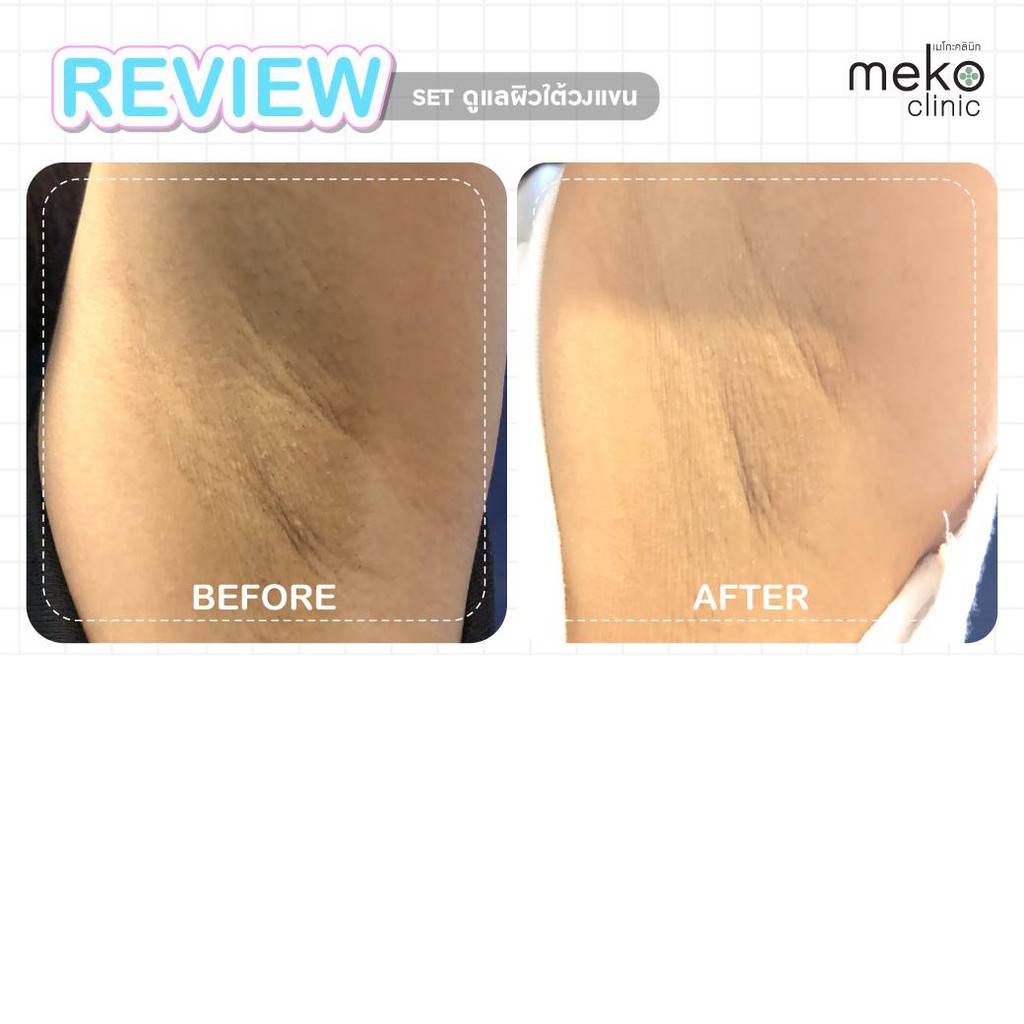 ครีมทารักแร้เนียน Smoothii Skin ii Skincare by Meko Clinic (30 ml) - รูปที่ 3