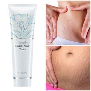 giffarine stretch mark cream