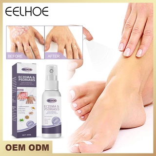 Eelhoe Tinea Pedis สเปรย์ครีมบํารุงผิวมือ ป้องกันเชื้อรา โรคผิวหนังศีรษะ 30 มล. 1 ชิ้น