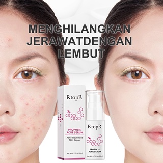RtopR เซรั่มลดสิว เผยผิวกระจ่างใส บอกลาปัญหาสิว สูตรช่วยลดสิวและควบคุมความมัน เซรัมบํารุงผิว ลดรอยแผลเป็นจากสิว บำรุงผิว 20ml