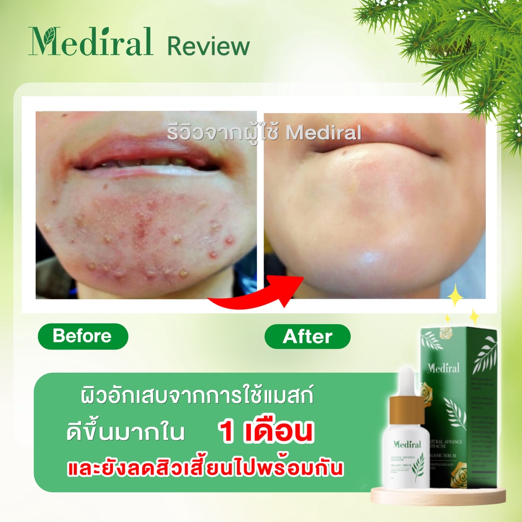 ของแท้ส่งฟรี!! Mediral เมดิรอล เซรั่มรักษาสิวสูตรคุณหมอ จบทุกปัญหาสิว ผิวอ่อนแอแพ้ง่าย เวชสำอางค์ที่แพทย์ผิวหนังแนะนำ