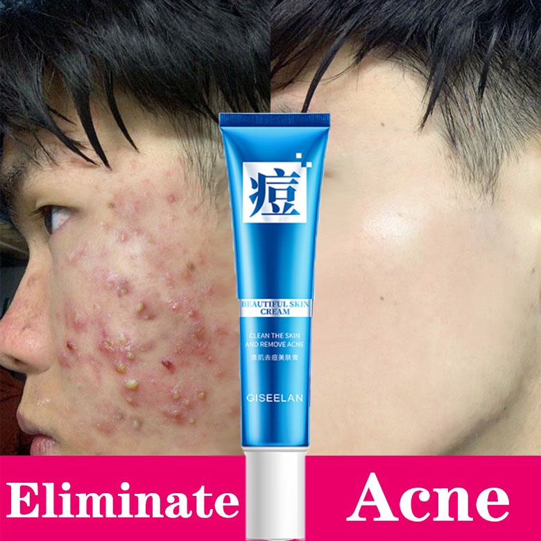 Acne Cream Pimple Remover Acne Remover Pimple Scar Remover Acne Treatment Pimple Extractor Acne Gel