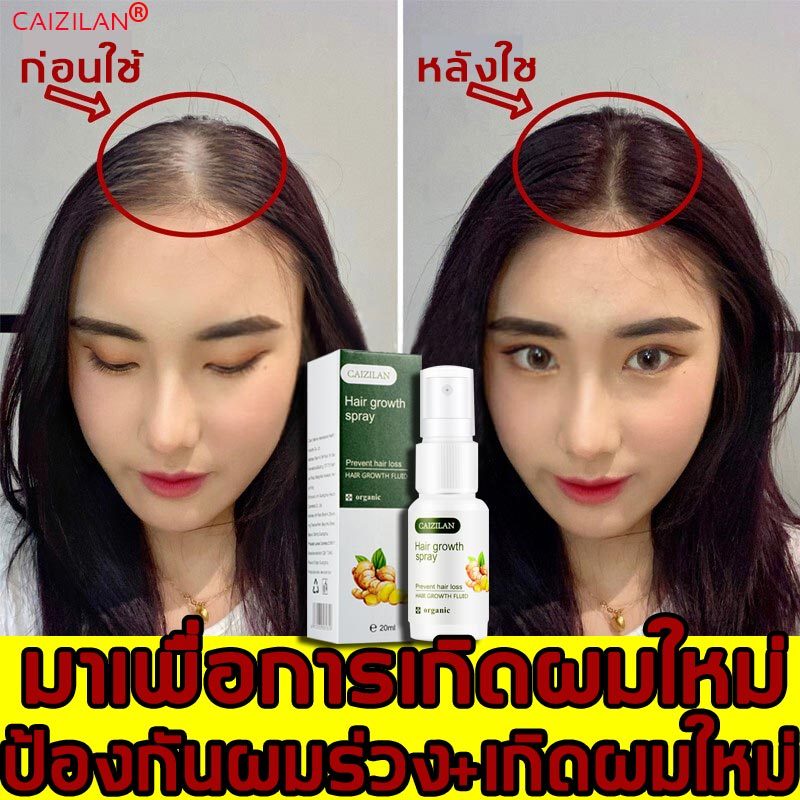 CAIZILAN สเปรย์ปลูกผม คุมมันอย่างมีประสิทธิภาพ หัวล้าน รักษาผมร่วง(น้ำยาเร่งผมยาว,ยาปลูกผมของแท้,น้ำยาปลูกผม,เซรั่มบำรุงผม,เซรั่มปลูกผม,เซรั่มใส่ผม,น้ำยาปลูกผมดก,สเปรย์ปปลูกผม,น้ำยาใส่ผม,เซรั่มเร่งผมยาว,น้ำยาปลูกผมชาย) Hair growth spray 20ml