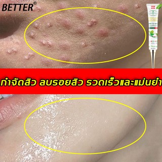 BETTER ครีมลบรอยดำสิว 30ml รักษาสิวอย่างล้ำลึก ซ่อมแซมรอยสิวและหลุมสิว ครีมลดรอยสิว ครีมแต้มสิว เซรั่มกำจัดสิว