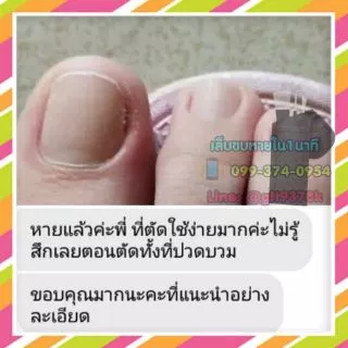 ตัดเล็บขบ​ แยกชิ้น หลายขนาด ตัดง่ายไม่เจ็บของแท้